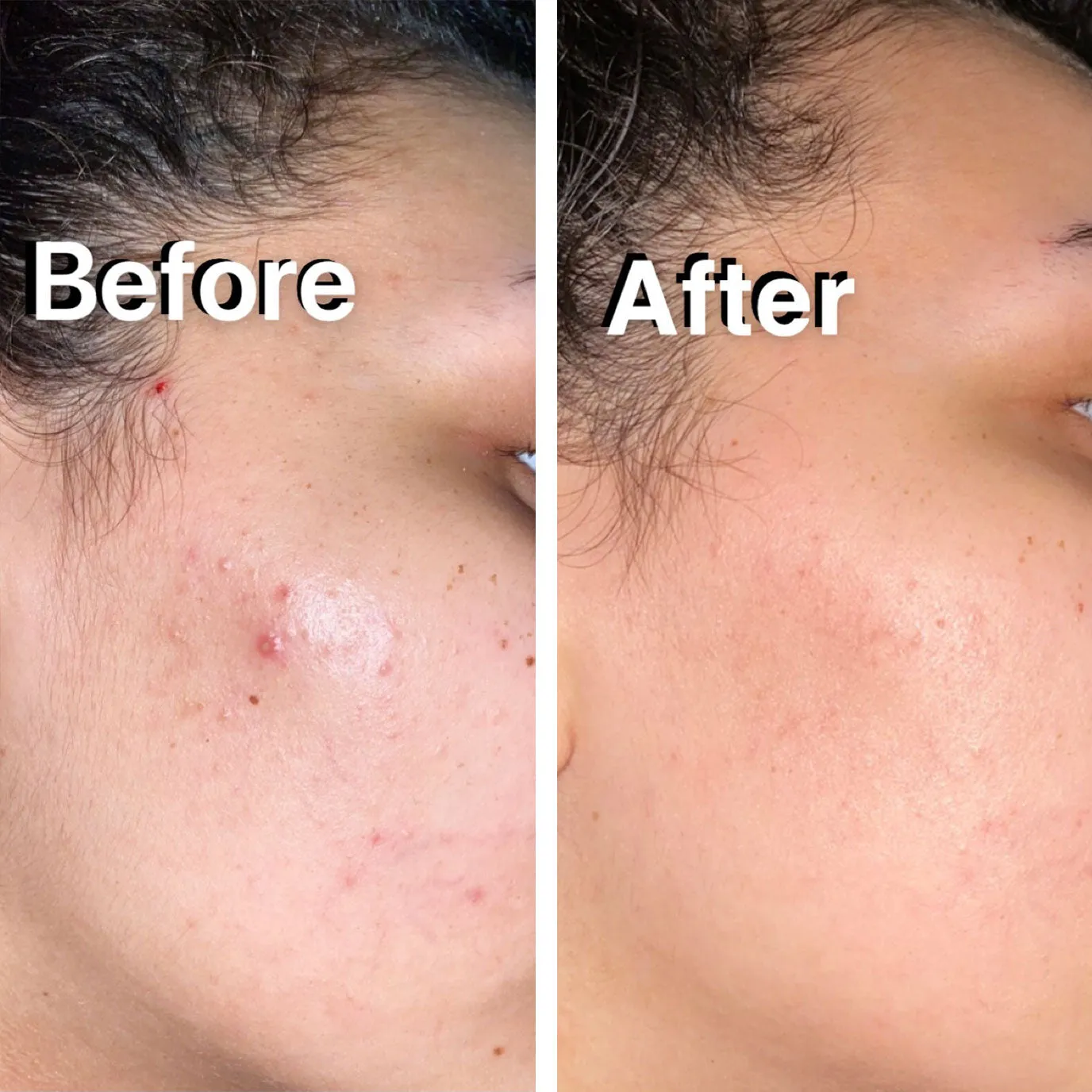 Anti-Acne Spot Cream   Free Concealer (Zit Kit)