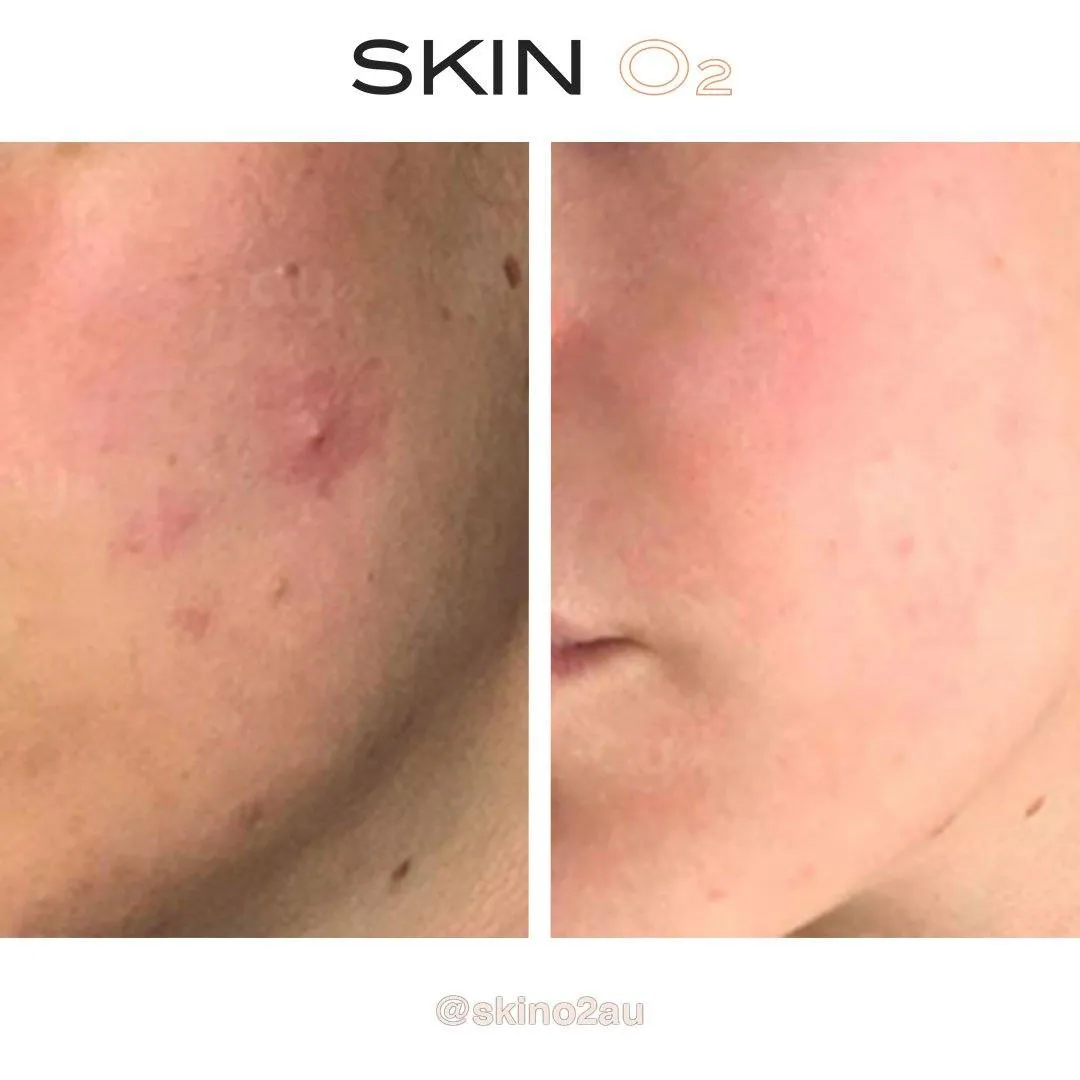 Anti-Acne Spot Cream   Free Concealer (Zit Kit)