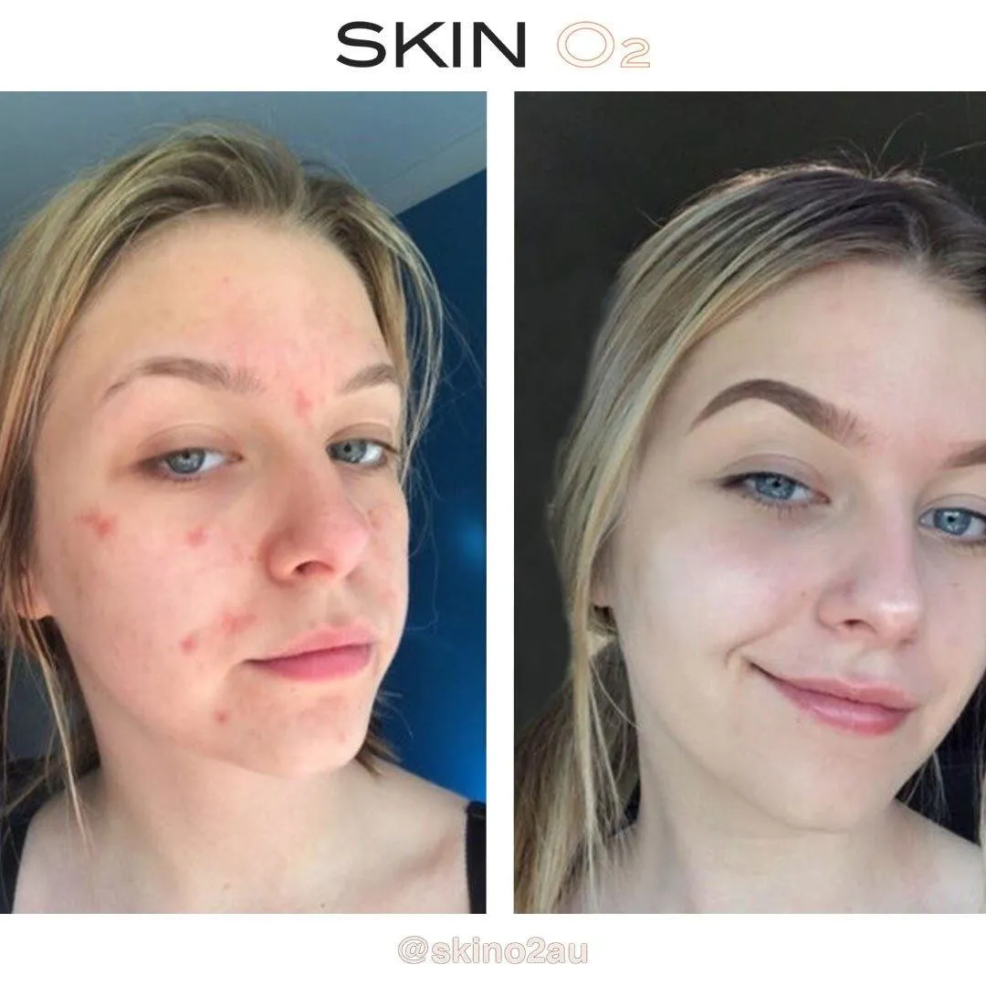 Anti-Acne Spot Cream   Free Concealer (Zit Kit)
