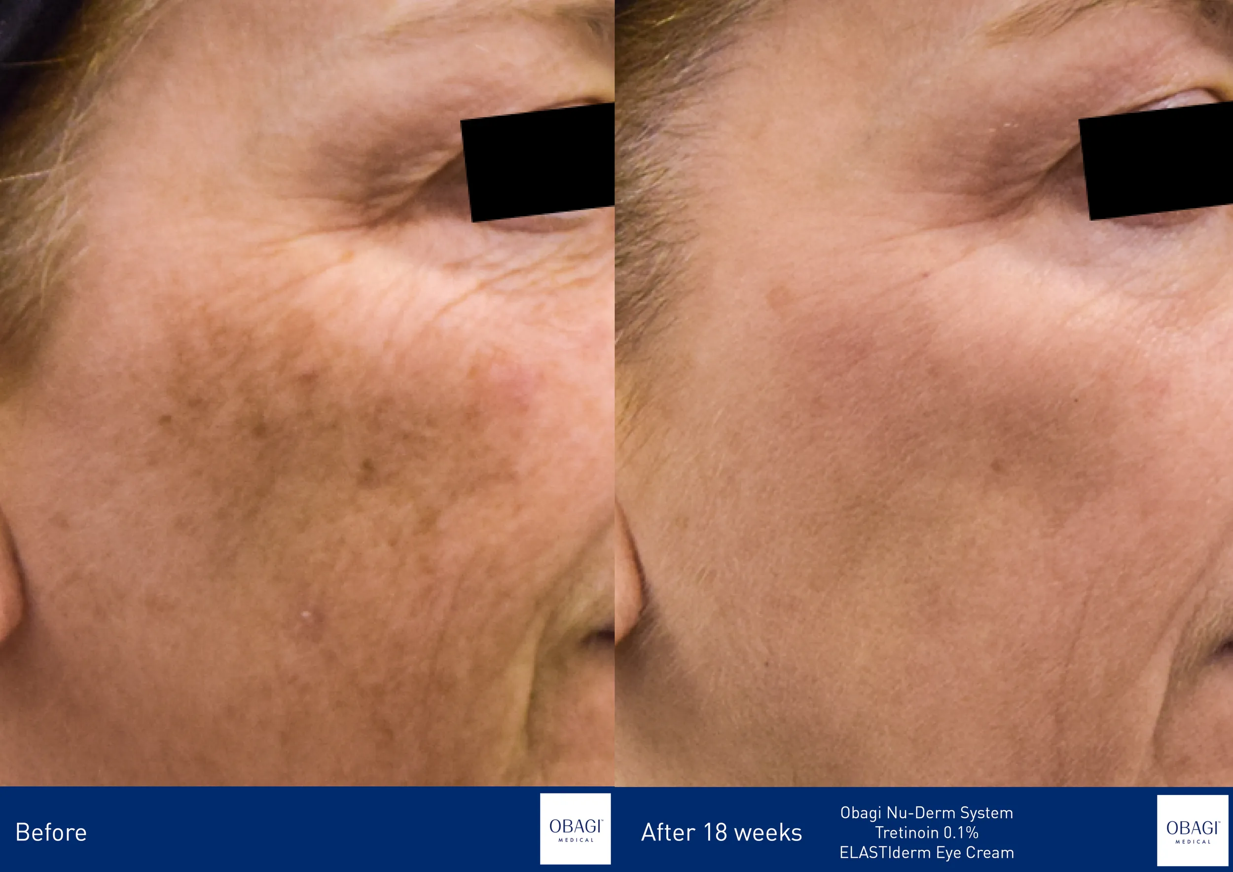 ELASTIderm Eye Cream